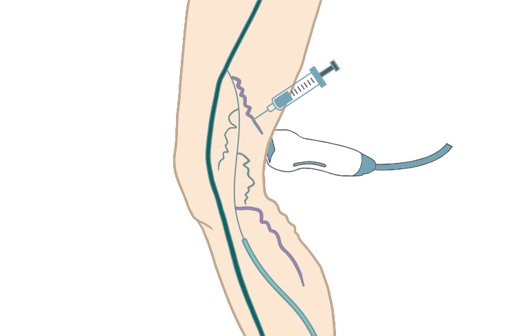 ultrasound for varicose veins