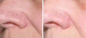 Why Do I have Red Spider Veins on My Face? - The Ultimate Vein Guide